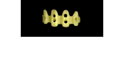 Ref.E2+E2 f Upper Anterior :  1x  white wax veneer-bridge, (23-13), carved to fit over its compatible yellow hollow pontic block-frame, (22-12) , both LARGE, Tapering ovoid , for porcelain pressed to metal bridgework
